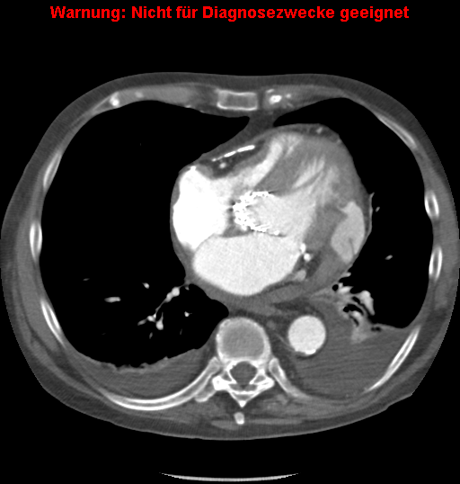 File:Cardiac perforation following transcatheter aortic valve implantation (Radiopaedia 23714-23863 A 7).png