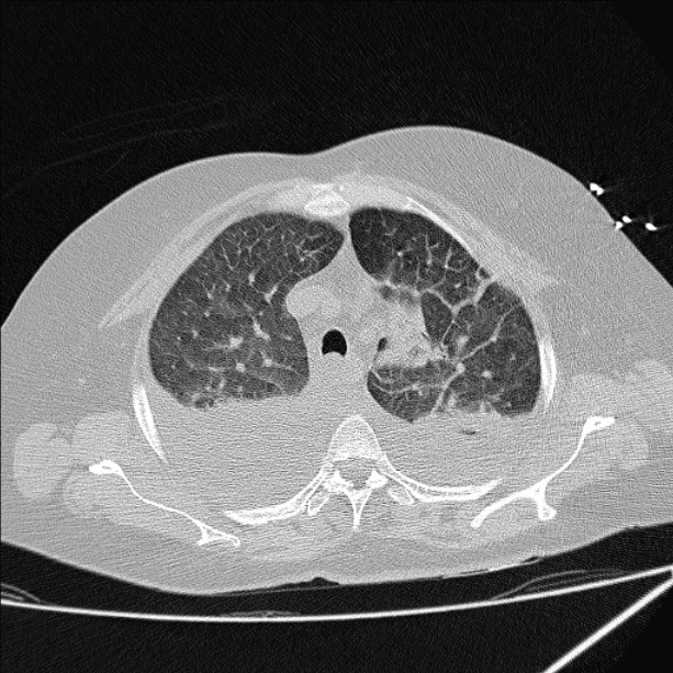 Cardiogenic pulmonary edema (Radiopaedia 29213-29609 Axial lung window 21).jpg