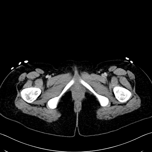 Caroli disease with medullary sponge kidney (Radiopaedia 82622-96804 C 81).jpg
