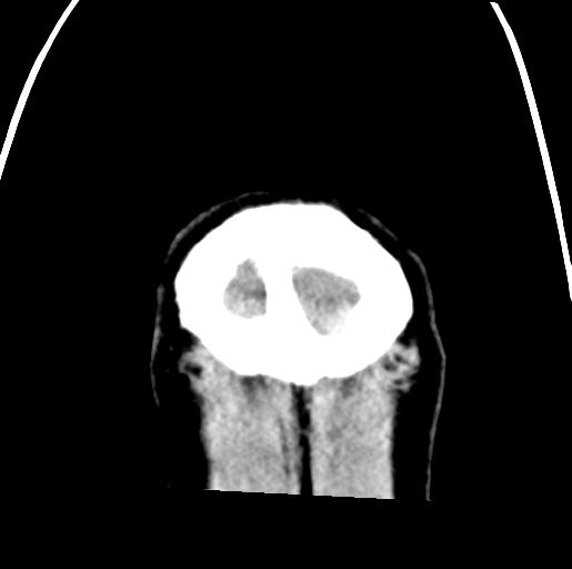 File:Carotid arterial dissection (Radiopaedia 30001-30551 Coronal non-contrast 48).jpg