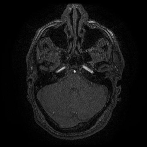 Carotid arterial dissection with acute cerebral infarction (Radiopaedia 26636-26784 MRA 135).jpg