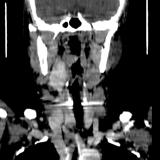 File:Carotid body tumor (Radiopaedia 27890-28124 B 12).jpg