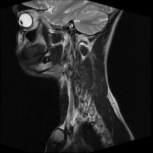 File:Carotid body tumor (Radiopaedia 30208-30823 Sagittal T2 6).jpg
