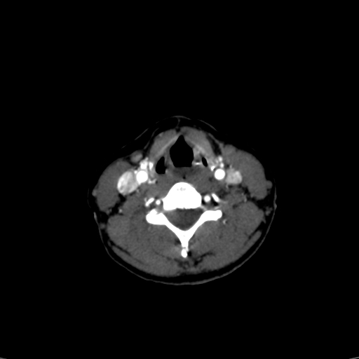 File:Carotid body tumor (Radiopaedia 39845-42300 B 16).jpg