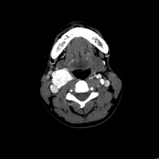 Carotid body tumor (Radiopaedia 39845-42300 B 37).jpg