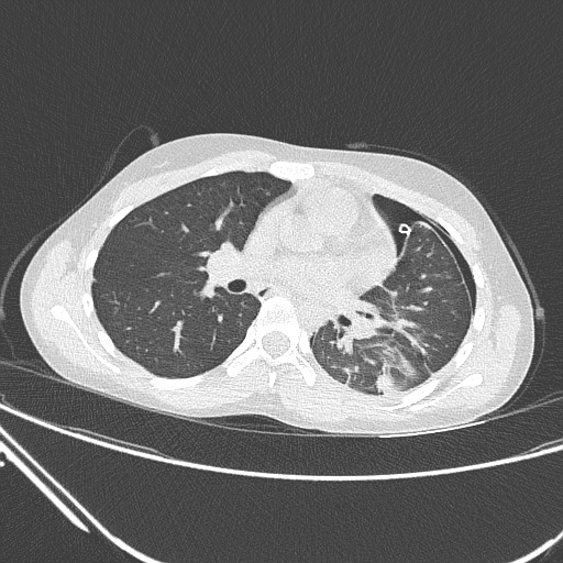 Catamenial pneumothorax (Radiopaedia 27946-28197 lung window 80).jpg