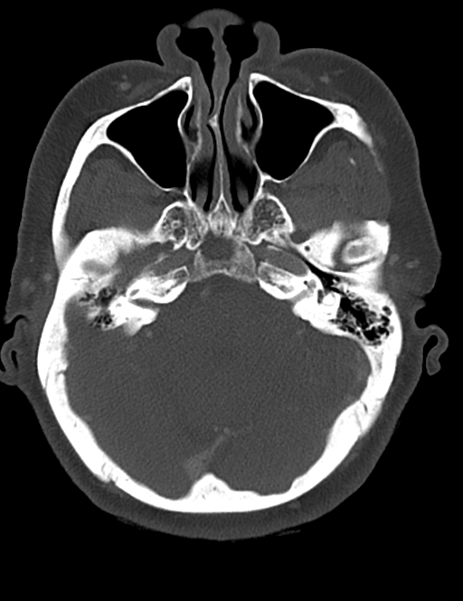 Causes of dysphagia (Radiopaedia 40149-42657 Axial bone window 5).png