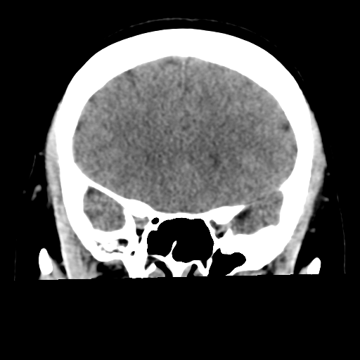 Cavernoma with hemorrhage (Radiopaedia 70755-80931 Coronal non-contrast 21).png