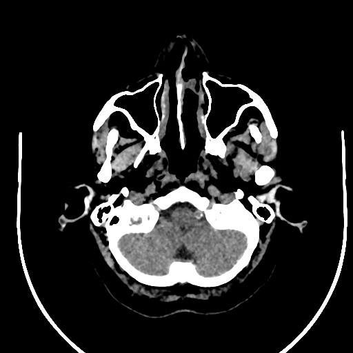 Cavernous hemangioma of the cerebellar falx (Radiopaedia 73025-83723 Axial non-contrast 14).jpg