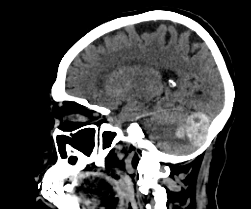 Cavernous hemangioma of the cerebellar falx (Radiopaedia 73025-83723 B 123).jpg