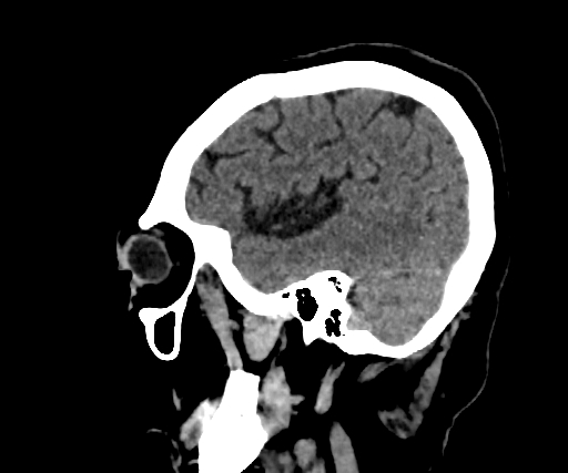 Cavernous hemangioma of the cerebellar falx (Radiopaedia 73025-83723 B 74).jpg