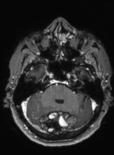 Cavernous hemangioma of the cerebellar falx (Radiopaedia 73025-83724 Axial T1 C+ 248).jpg