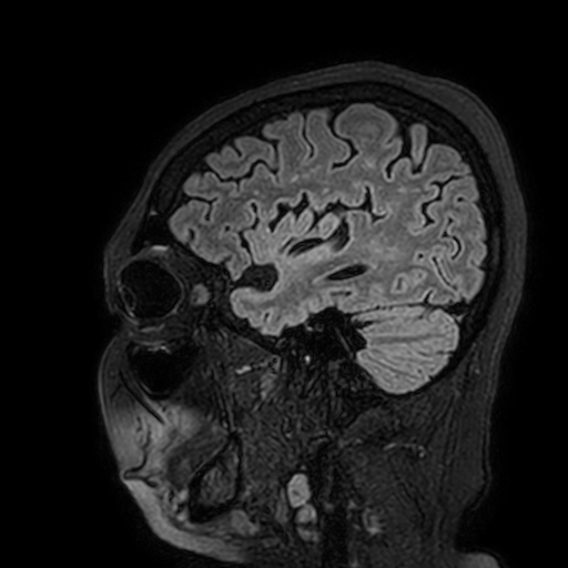 Cavernous hemangioma of the cerebellar falx (Radiopaedia 73025-83724 Sagittal FLAIR 42).jpg