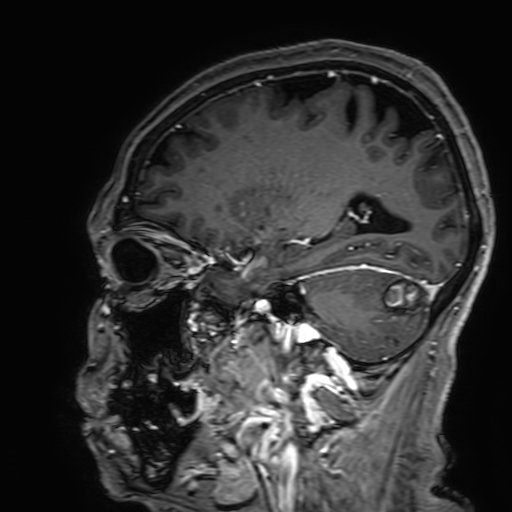Cavernous hemangioma of the cerebellar falx (Radiopaedia 73025-83724 Sagittal T1 C+ 144).jpg