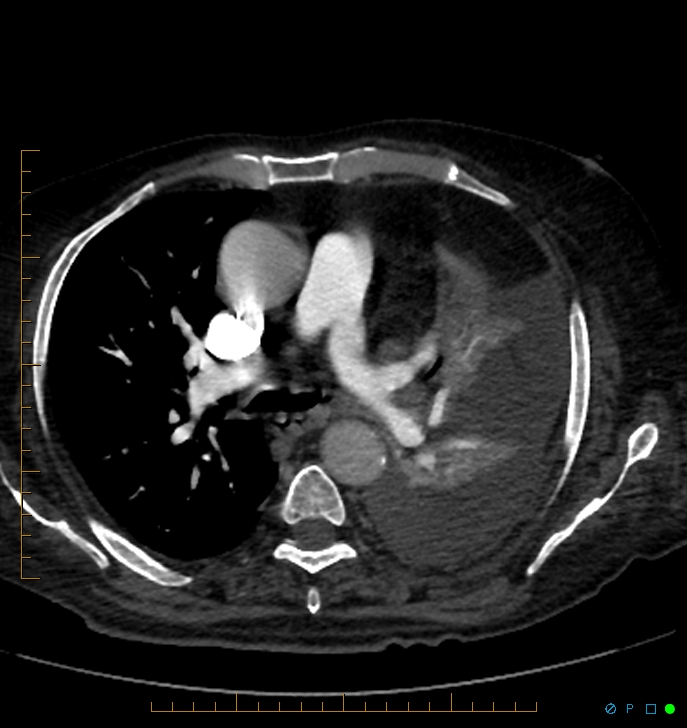 Cavitating pulmonary infarction (Radiopaedia 54634-60849 Axial C+ CTPA 32).jpg