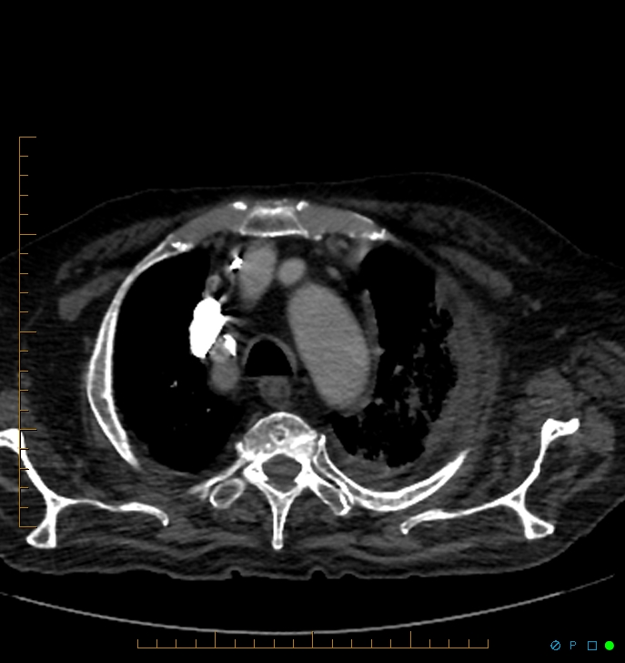 Cavitating pulmonary infarction (Radiopaedia 54634-60849 Axial C+ CTPA 8).jpg