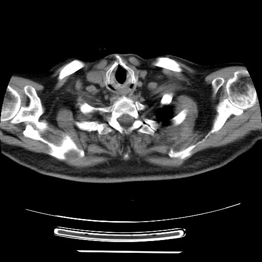 Cavitating pulmonary metastases (Radiopaedia 89545-106544 Axial non-contrast 2).jpg