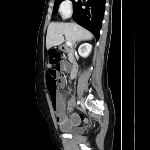 Cecal adenocarcinoma (Radiopaedia 75909-87331 C 31).jpg