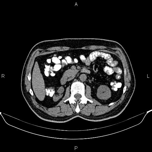 Cecal adenocarcinoma (Radiopaedia 85324-100916 Axial non-contrast 39).jpg