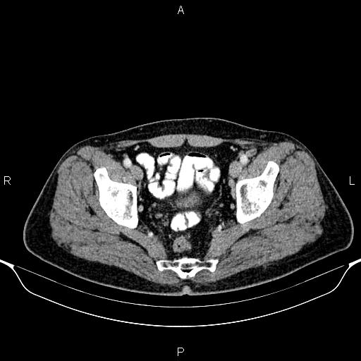 Cecal adenocarcinoma (Radiopaedia 85324-100916 B 88).jpg