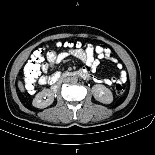 File:Cecal cancer with appendiceal mucocele (Radiopaedia 91080-108651 Axial C+ delayed 29).jpg