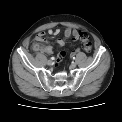 Cecal mass causing appendicitis (Radiopaedia 59207-66531 A 68).jpg