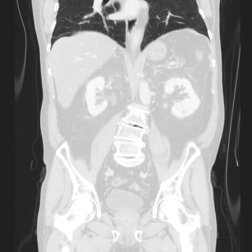 Cecal volvulus (Radiopaedia 75378-86620 Coronal lung window 86).jpg