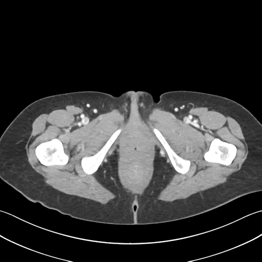 Cecum hernia through the foramen of Winslow (Radiopaedia 46634-51112 A 80).png