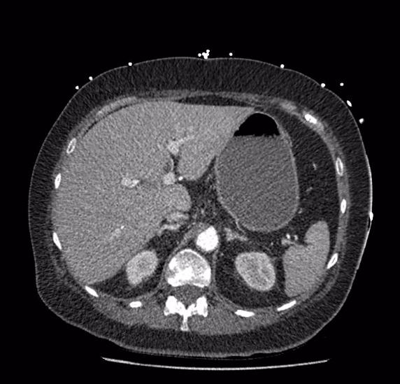 Celiac artery severe stenosis and dissection (Radiopaedia 44128-47842 B 21).jpg