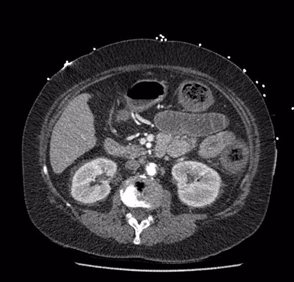 Celiac artery severe stenosis and dissection (Radiopaedia 44128-47842 B 39).jpg