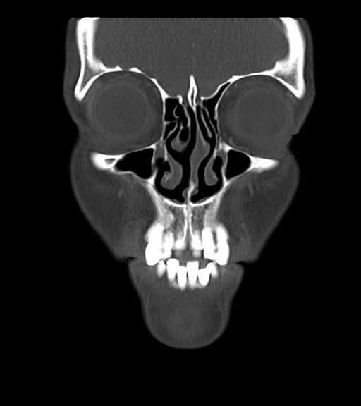 Cemento-ossifying fibroma (Radiopaedia 46243-50643 Coronal bone window 15).png