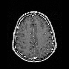 File:Central-variant posterior reversible encephalopathy syndrome (PRES) (Radiopaedia 43880-47358 Axial T1 C+ 126).jpg