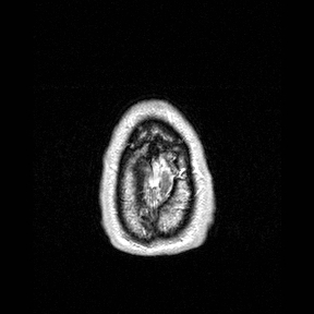 Central-variant posterior reversible encephalopathy syndrome (PRES) (Radiopaedia 43880-47358 Axial T1 C+ 166).jpg