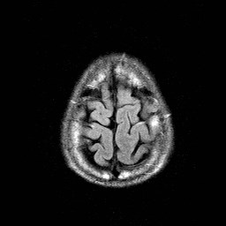 File:Central-variant posterior reversible encephalopathy syndrome (PRES) (Radiopaedia 43880-47359 Axial FLAIR 22).jpg