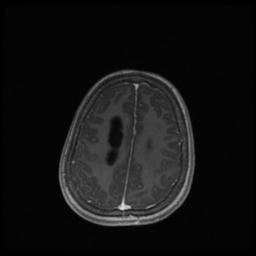 Central neurocytoma (Radiopaedia 30220-30842 Axial T1 C+ 118).jpg