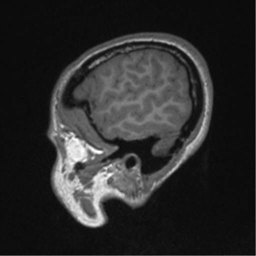 Central neurocytoma (Radiopaedia 37664-39557 Sagittal T1 16).png