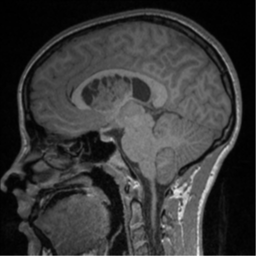 Central neurocytoma (Radiopaedia 37664-39557 Sagittal T1 52).png