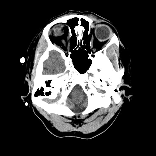 Central neurocytoma (Radiopaedia 68725-78432 Axial non-contrast 7).jpg