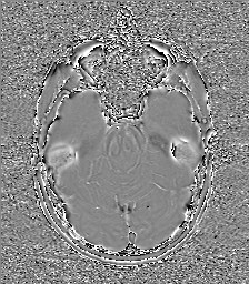 Central neurocytoma (Radiopaedia 84497-99872 Axial 23).jpg