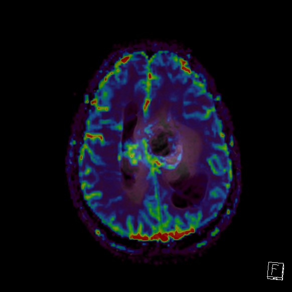 Central neurocytoma (Radiopaedia 84497-99872 Axial Perfusion 102).jpg