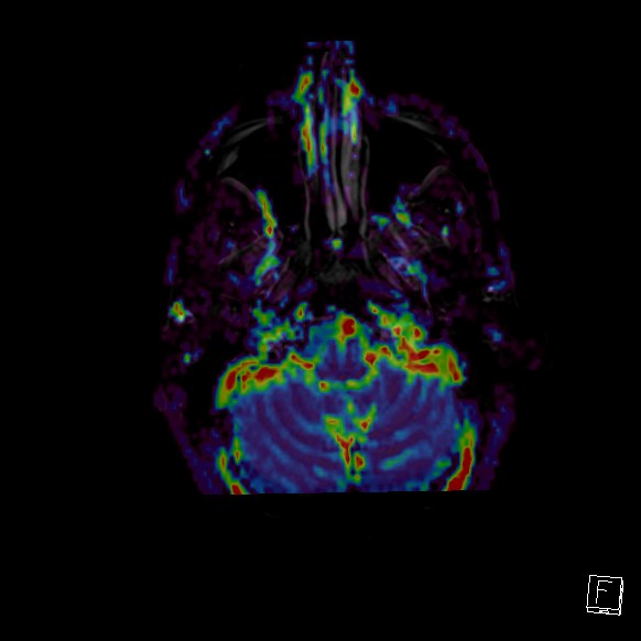 Central neurocytoma (Radiopaedia 84497-99872 Axial Perfusion 278).jpg