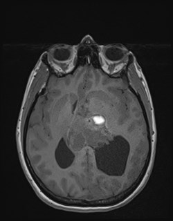 Central neurocytoma (Radiopaedia 84497-99872 Axial T1 105).jpg