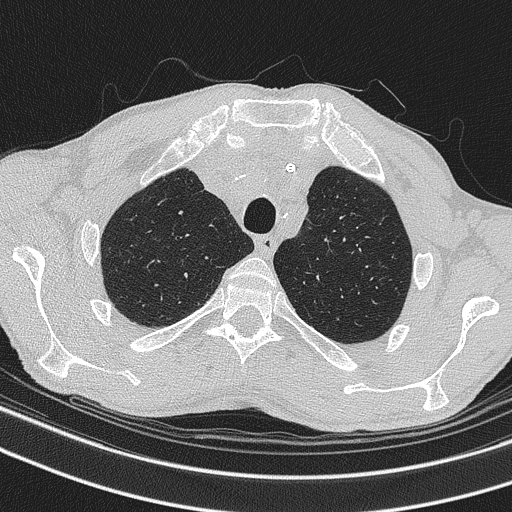 Central venous catheter tip extravasation (Radiopaedia 82828-97113 Axial lung window 19).jpg