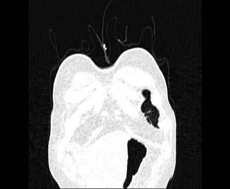 Centrilobular pulmonary emphysema (Radiopaedia 62468-70718 Coronal lung window 6).jpg