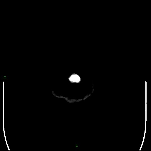 Cerebellar abscess (Radiopaedia 78135-90671 Axial non-contrast 119).jpg
