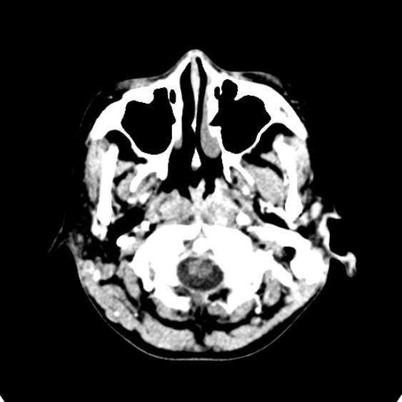 Cerebellar abscess secondary to mastoiditis (Radiopaedia 26284-26412 Axial C+ delayed 8).jpg