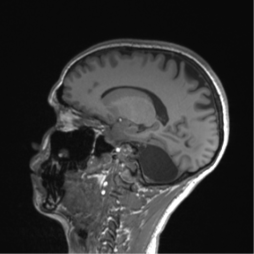 Cerebellar agenesis with hypoplastic pons (pontocerebellar hypoplasia) (Radiopaedia 57224-64138 Sagittal T1 42).png