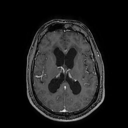 Cerebellar hemangioblastoma (Radiopaedia 88055-104622 Axial T1 C+ 103).jpg
