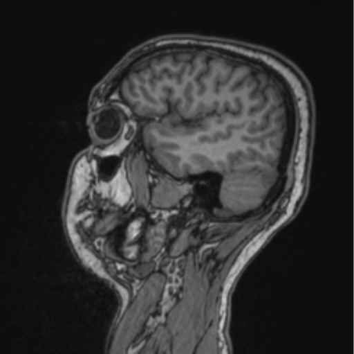 File:Cerebellar hemangioblastomas and pituitary adenoma (Radiopaedia 85490-101176 Sagittal T1 73).png