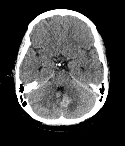 File:Cerebellar metastases - colorectal adenocarcinoma (Radiopaedia 40947-43652 Axial non-contrast 20).png